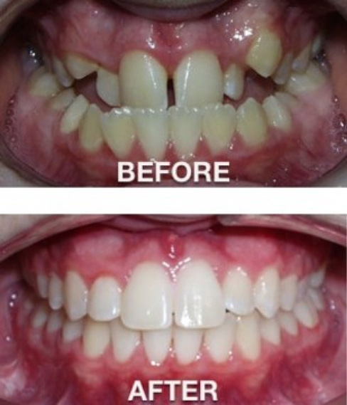 San Antonio Orthodontist Before and After Picture 2