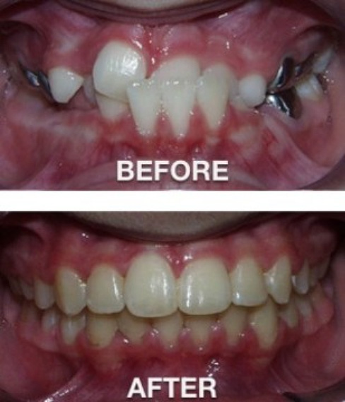 San Antonio Orthodontist Before and After Picture 3
