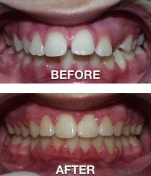 San Antonio Orthodontist Before and After Picture 4