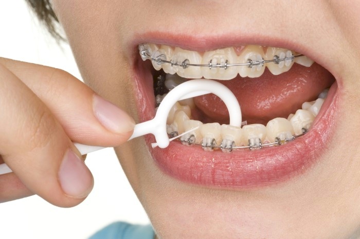 San Antonio Orthodontist explains how to floss with braces