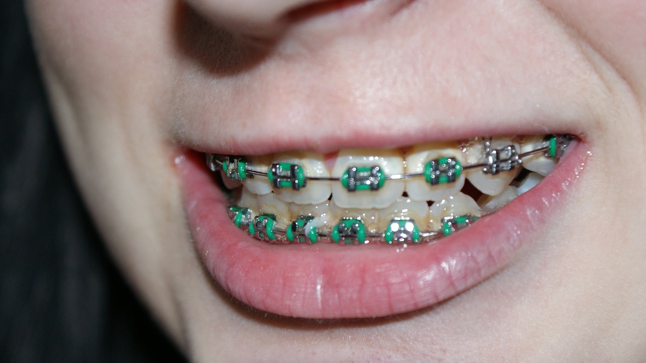 What to expect before getting braces in San Antonio Texas